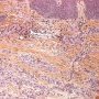 Plexiform fibrohistiocytic tumor