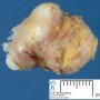 Mammary fibroadenoma