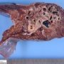 Pulmonary arteriovenous malformation in Hereditary hemorrhagic (...)