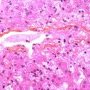 Autoimmune hepatitis