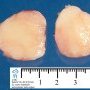 Mammary hamartoma