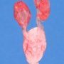Short ureters with megacystis
