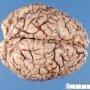 Normal brain