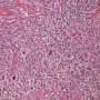 Hodkin lymphoma