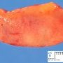 Nodal Castleman disease