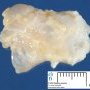 Popliteal synovial cyst