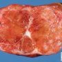 Focal nodular hyperplasia