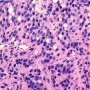Gleason pattern 5 (WebPathology)