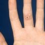 Digital epithelioid dermatofibroma