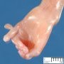 Bilateral cleft lip/palate, omphalocele, postaxial polydactyly in trisomy (...)