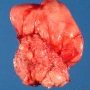 Mature lipoma