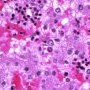 Parvoviral inclusion in fetal liver (hydrops fetalis)