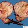Cystic Wilms tumor