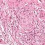 Periductal lymphocytic infiltrate in auto-immune sclerosing (...)