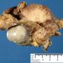 Peritoneal desmoplastic small round cell tumor