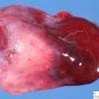 extralobar pulmonary sequestration