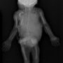 D12-L2 ertebral anomalies