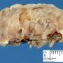 Infantile hemangioma
