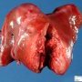 Hepatoblastoma