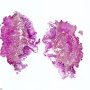 Lingual lymphangioma