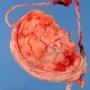 Partial placenta circumvallata with long umbilical cord