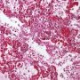 Acute pneumonia in bacterial pneumonia