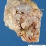 Femoral osteochondroma