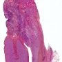 Paratesticular embryonal rhabdomyosarcoma