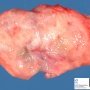 Invasive pulmonary aspergillosis