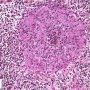Suppurative epithelioid granuloma in a chalazion