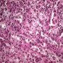 Foamy macrophages in splenic red pulp