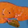 Steatotic liver