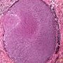 Basaloid pilomatricoma