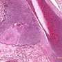 Basaloid pilomatricoma