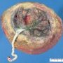 Placenta circumvallata with marginal insertion