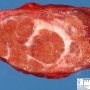 Focal nodular hyperplasia