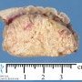 Pilomatrixoma. Section. Macroscopy