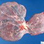 Bilobar placenta with central insertion of the umbilical cord