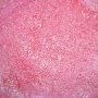 Invasive pulmonary aspergillosis