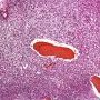 Bone marrow localization of classic Hodgkin lymphoma