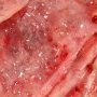 Cystic partially differentiated nephroblastoma