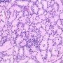 Gleason Pattern 4 (WebPathology)