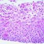 Eosinophilic oesophagitis