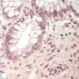 Inflammatory apoptotic cells in chronic colitis