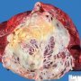 Splenic epidermoid cyst