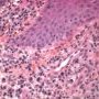 Secondary syphilis (Courtesy of Victor Kokta)