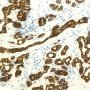 Post-atrophic Hyperplasia - 34bE12 Immunostain