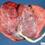 Placenta percreta