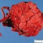 Marginal placental hematoma