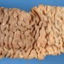 Colectomy of ulcerative colitis